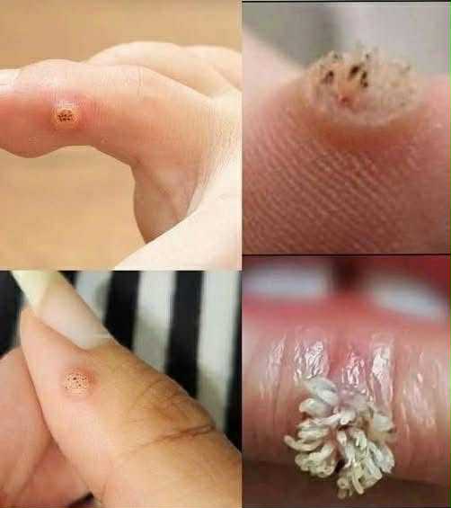 To BE VERY CAREFUL, If you get this, you are infected with!