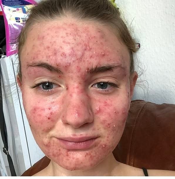When Itching Became a Warning Sign