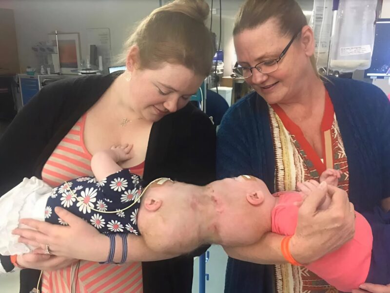 Siamese twin sisters were born with their heads joined, but at 1 year old doctors separated them: Here’s what the girls look like today
